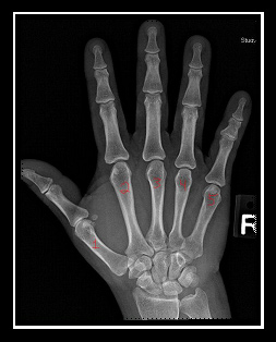 fractured knuckle symptoms