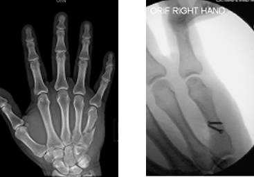 Hairline Fracture Hand