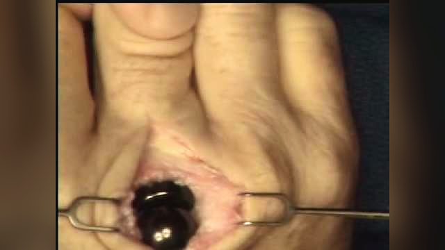 What does arthritis surgery of the hand involve?