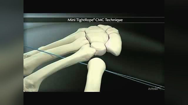 How does the Mini TightRope suspend the thumb after a trapezial resection?
