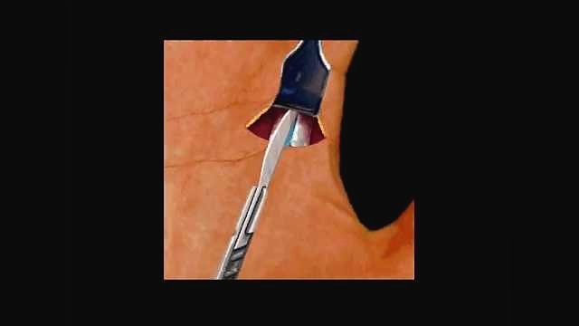 Trigger Finger Surgery