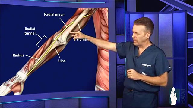 What is radial tunnel syndrome and how is it treated?