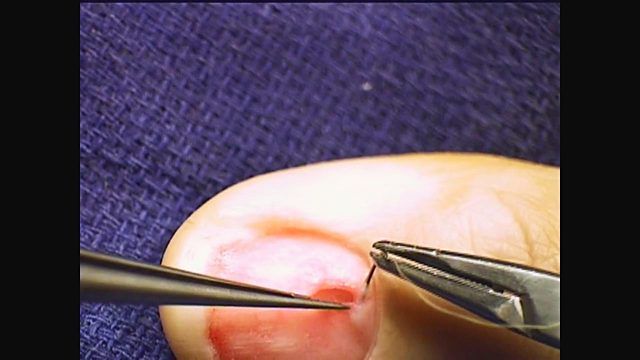 What is a glomus tumor and why is it so painful?