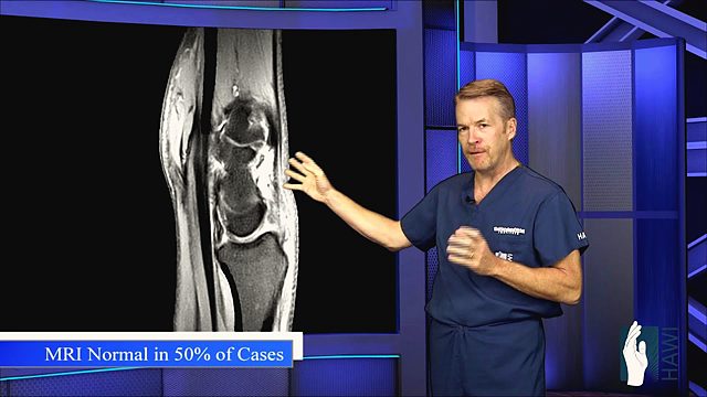 What is a ganglion cyst and how is it removed?