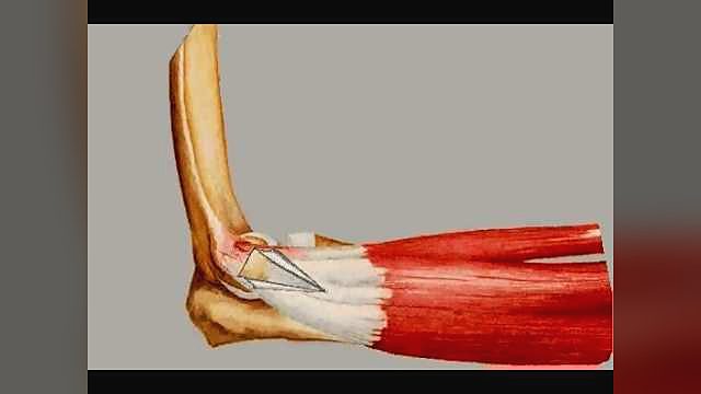 What is tennis elbow?