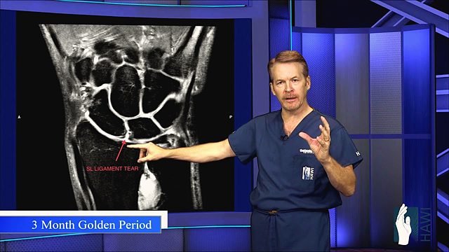 What is a torn wrist ligament and how is it repaired?