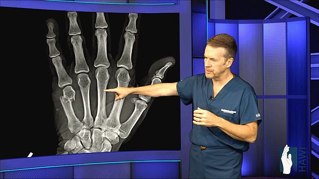 How is a broken hand treated?