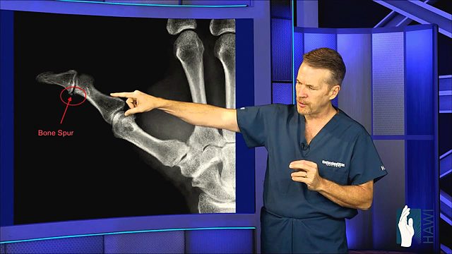 What is a mucoid cyst on a finger and how is it removed?