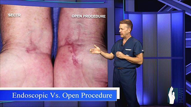 Our poster for the video comparing open and endoscopic carpal tunnel release.