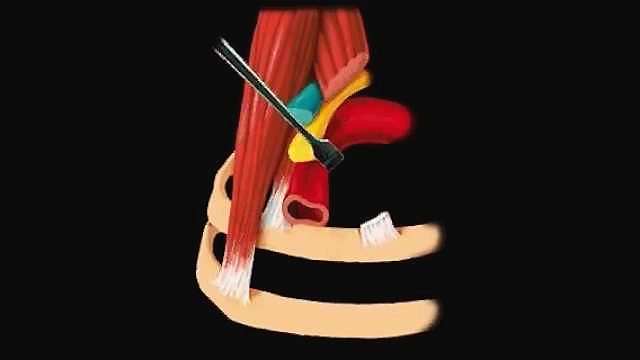 Thoracic Outlet Syndrome