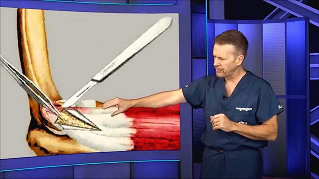 What is tennis elbow and how is it treated?