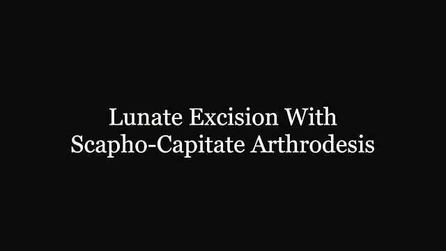 What happens during a lunate excision with scaphocapitate fusion?
