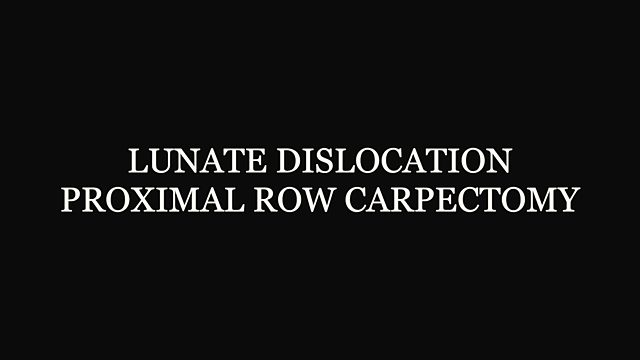 What happens during a proximal row carpectomy for a lunate dislocation?
