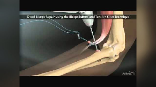 How is a torn distal biceps tendon repaired?