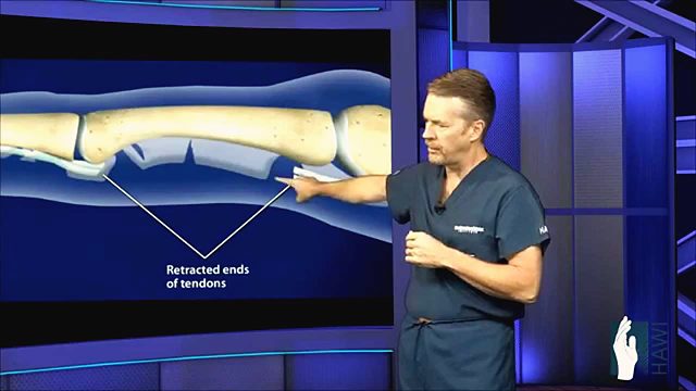 What happens when a flexor tendon is cut, and how is it repaired?