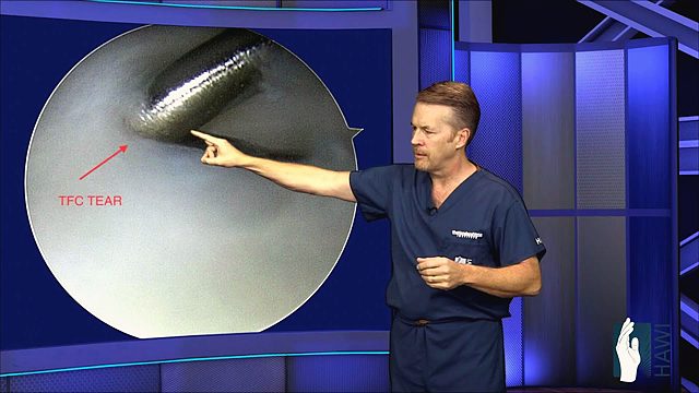 What is a TFCC tear and how is it treated?