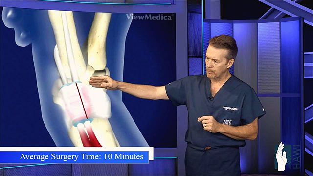What is De Quervain’s tenosynovitis, or mommy thumb?
