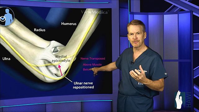 What is cubital tunnel syndrome and how is it treated?