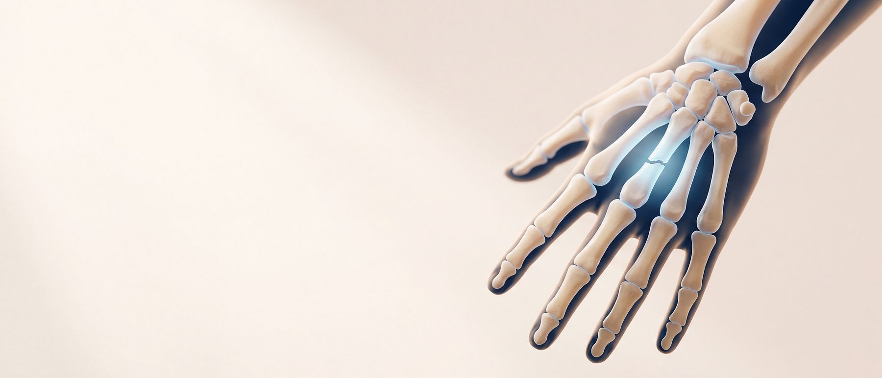 A three-dimensional illustration of a hand with a single clean break across one of its long bones, lit in blue.