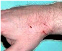 dog bite hand infection