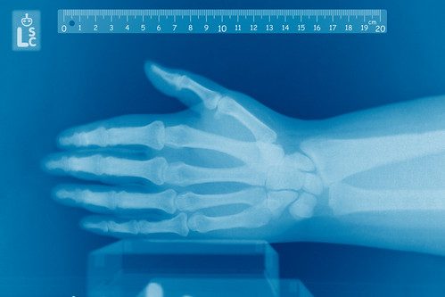Ligament Injuries In The Fingers - Hand - Conditions - Musculoskeletal -  What We Treat 