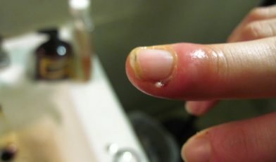 finger with infection under nail