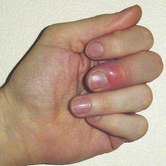 Cuticles: What Are They, Care, Signs of Infection | Hand & Wrist Institute