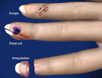 Nail Bed Injury Healing Time Treatments