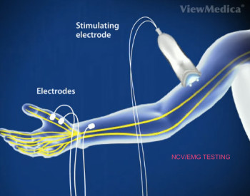 Ulnar Tunnel Syndrome: Exercies, Treatment, & More