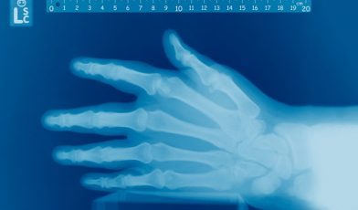 An X-ray of someone's left hand with a ruler at the top all in blue shades.