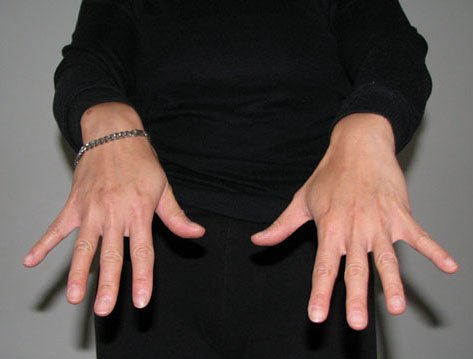 11 Trigger Finger Exercises To Help Your Pain