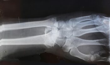 how do you treat a hyperextended wrist?