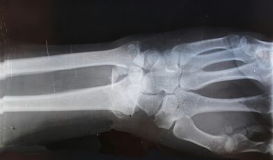 how do you treat a hyperextended wrist?