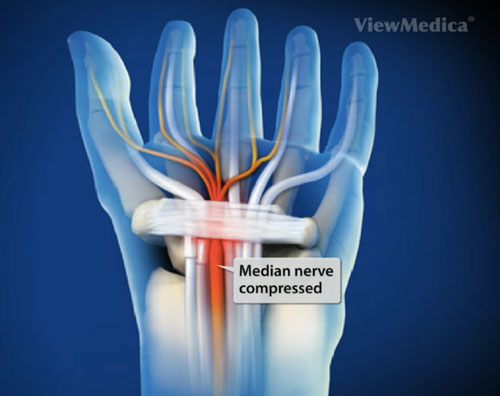 Compression of the Median Nerve￼ – Specialists On Hand