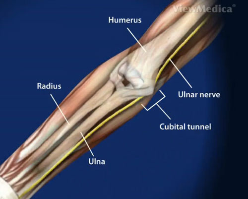 Cubital Tunnel Syndrome Exercises & Treatment in Dallas, TX