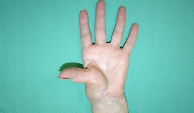 Hand palm up with fingers spread displaying a symptom of arthritis.