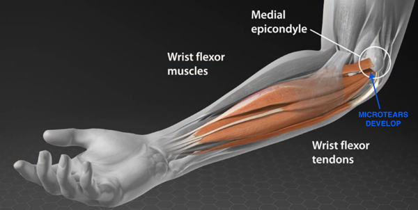What is Golfer’s Elbow? illustration