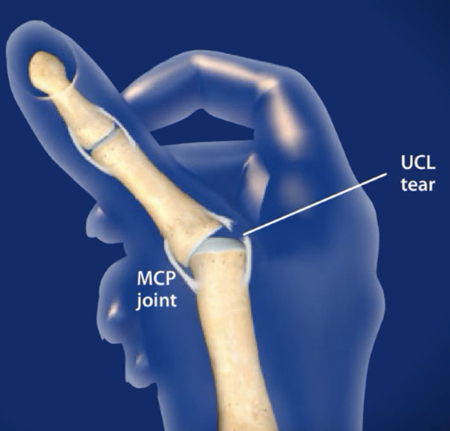 gamekeeper's thumb treatment in dallas, tx