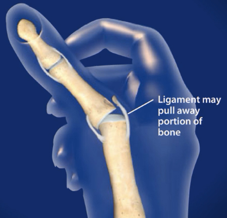 thumb ligament pulling away from a portion of bone