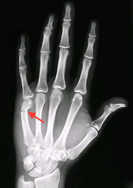 How is a Boxer’s Fracture diagnosed? illustration