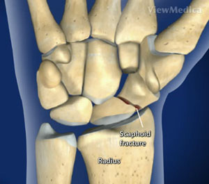 scaphoid fracture treatment in dallas, tx
