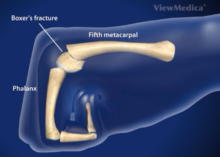 What is a Boxer’s Fracture? illustration
