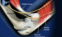 What To Expect During the Radial Nerve Healing Process