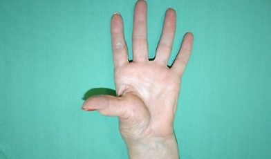 types of arthritis in hand