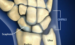 What Is a Scaphoid Fracture?